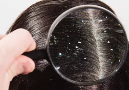 ketombe adalah jamur