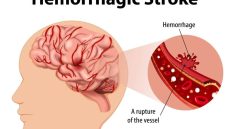 pembuluh darah pecah