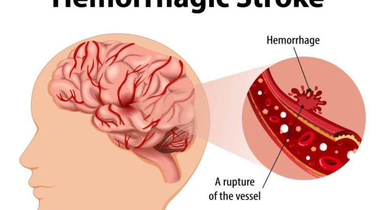pembuluh darah pecah