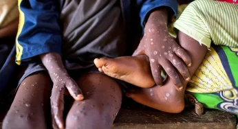 Kasus Mpox Melonjak Lagi, WHO Umumkan Status Darurat