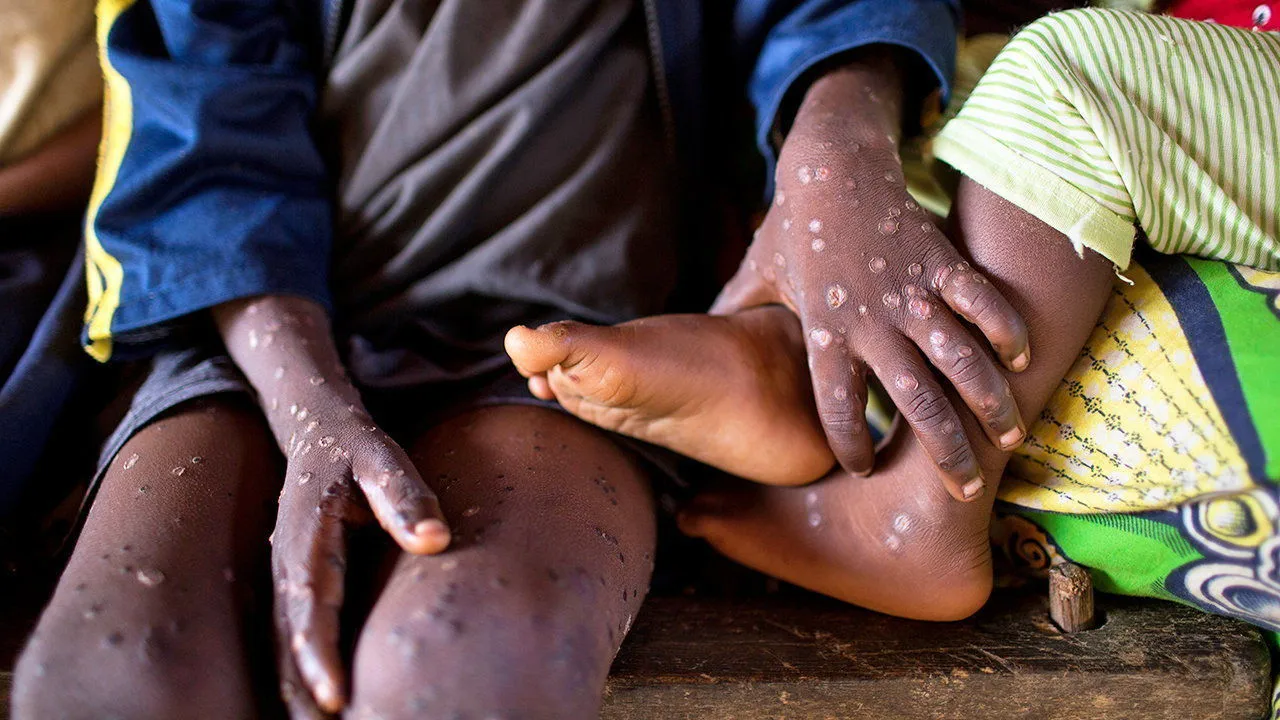 mpox