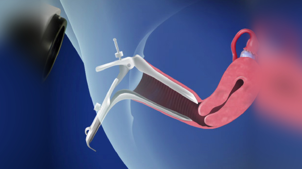 pap smear