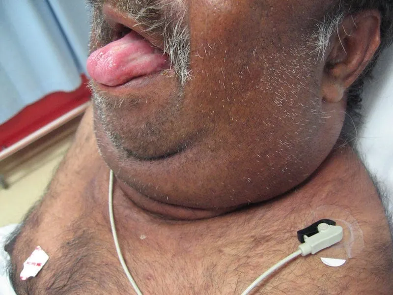 ludwig angina